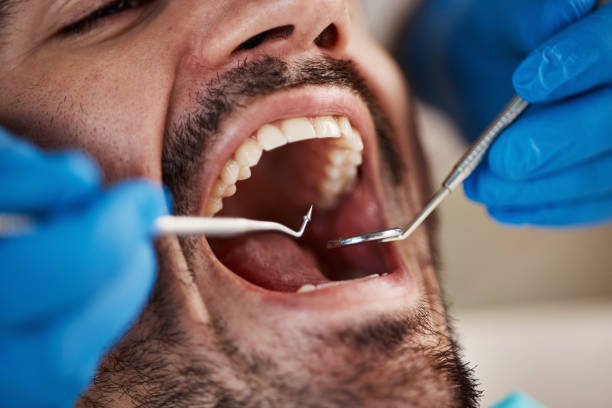 Best Chipped Tooth Repair Near Me  in Panguitch, UT
